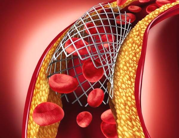 【力美新材料】生物可吸收支架获批，近百万冠心病患者或因此受益